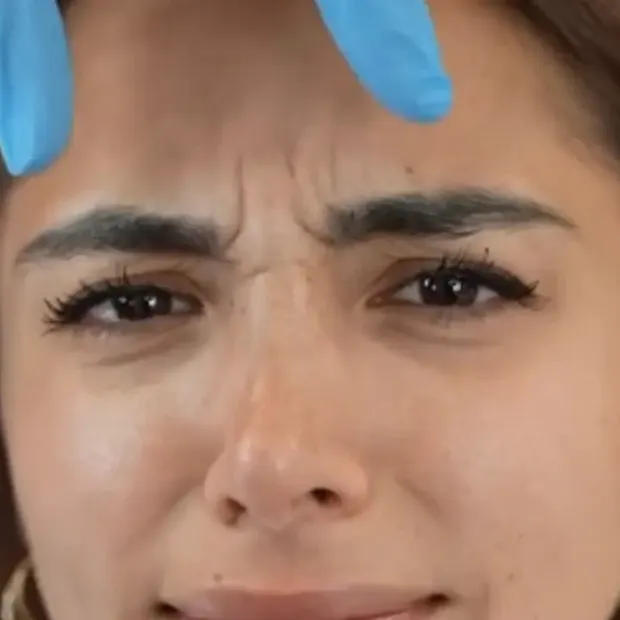 Sandra Pica tratamiento de ácido hialurónico