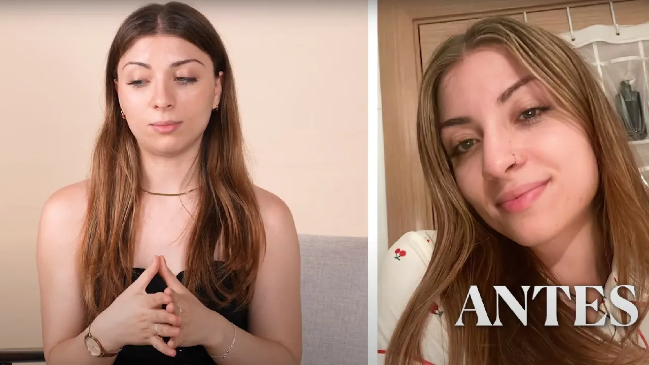 Andrea y rinoplastia ultrasónica