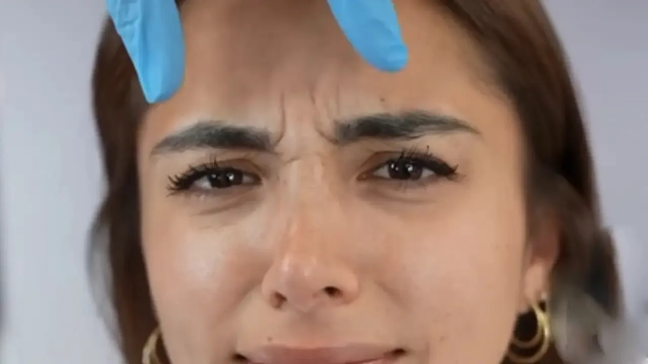 Sandra Pica tratamiento de ácido hialurónico